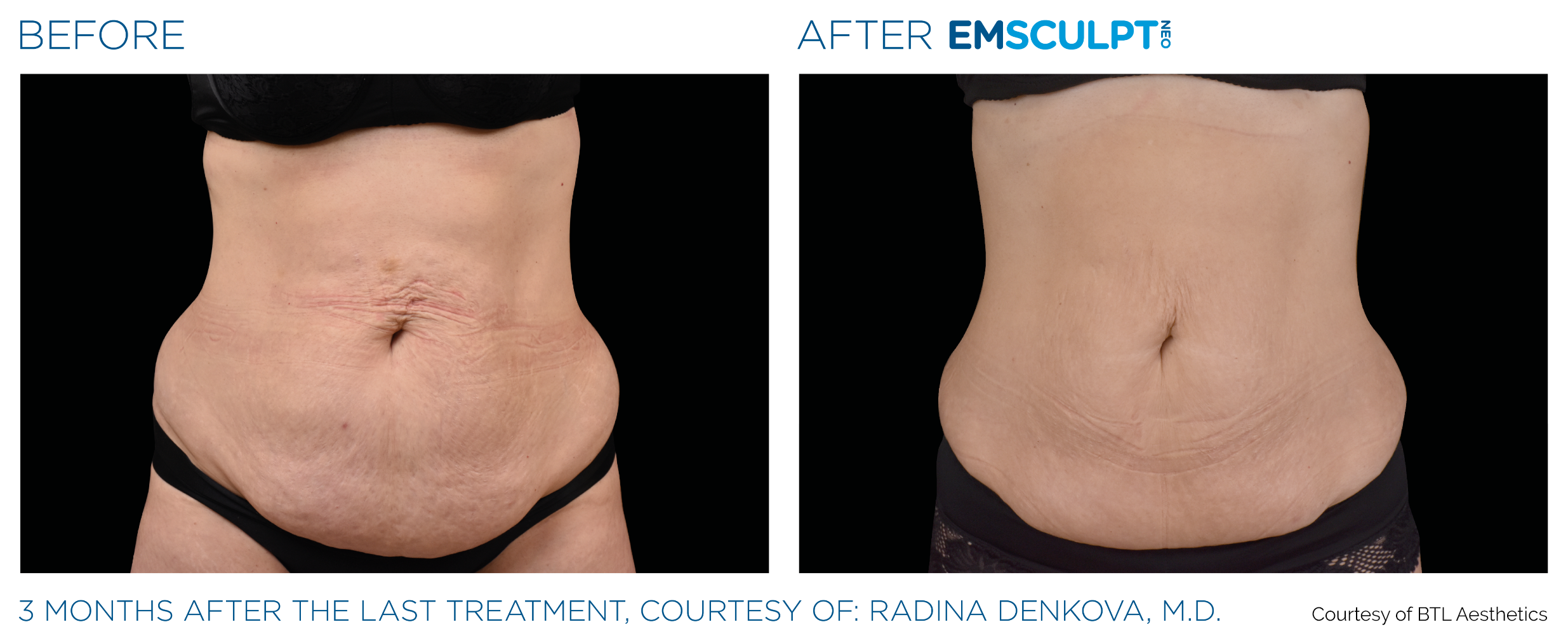 Emsculpt_PIC_Ba-card-female-belly-078_For-neo_ENUS100