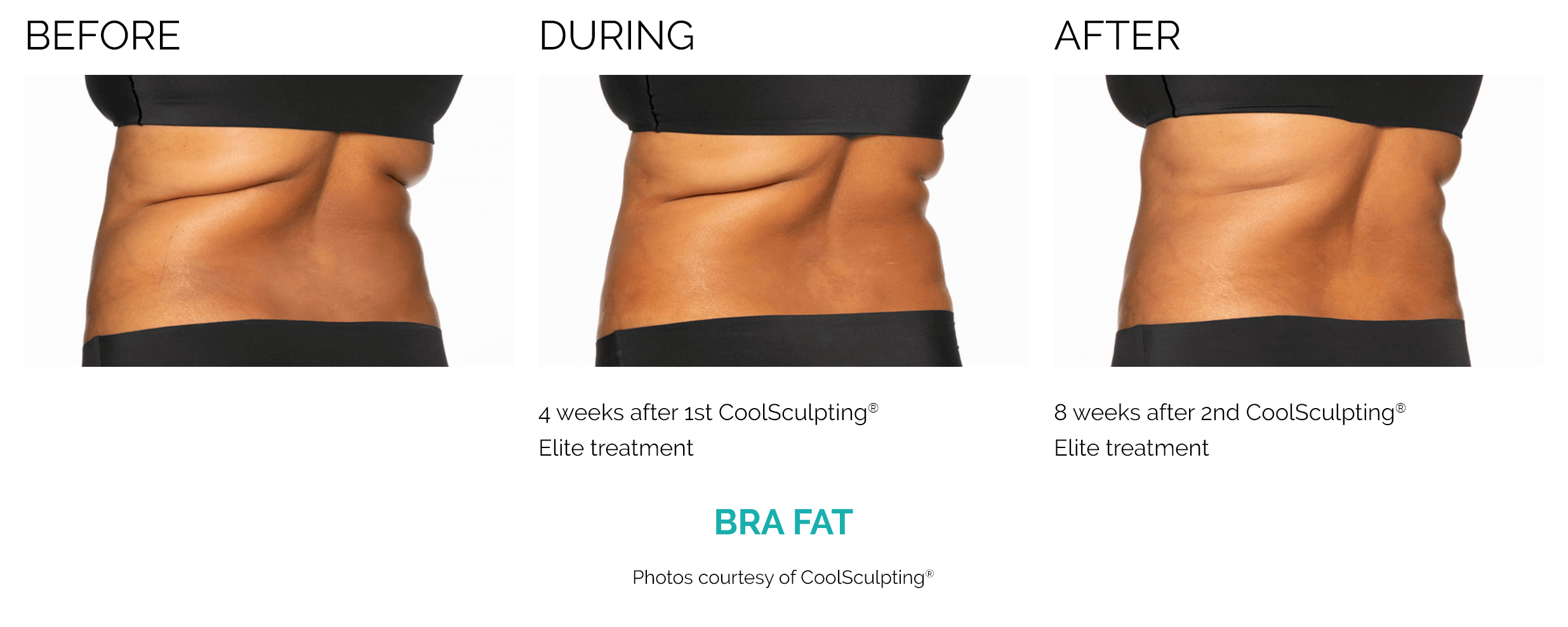 coolsculpting_bf6