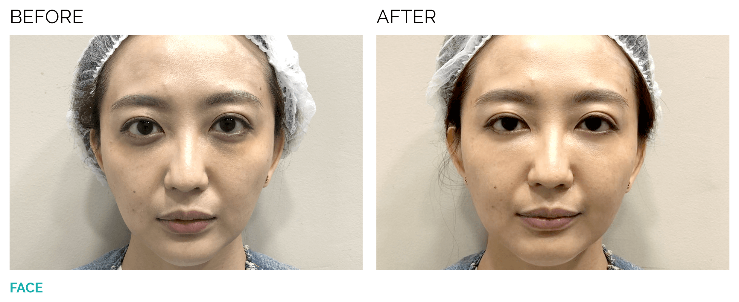 juvederm_voluma_bf1