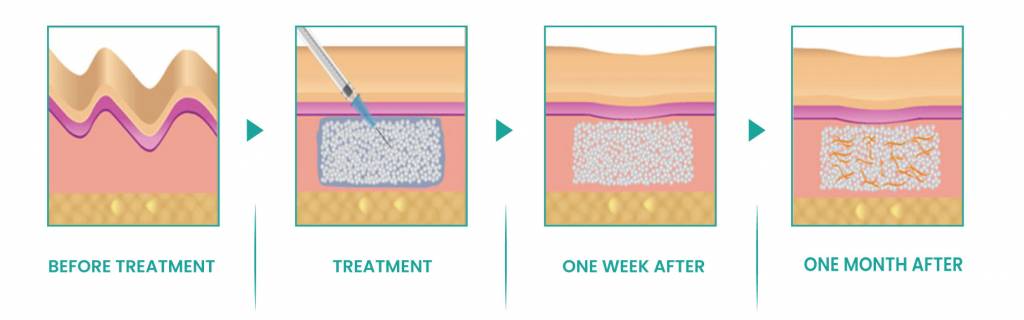 This is the process of how Aesthefill filler works for the skin