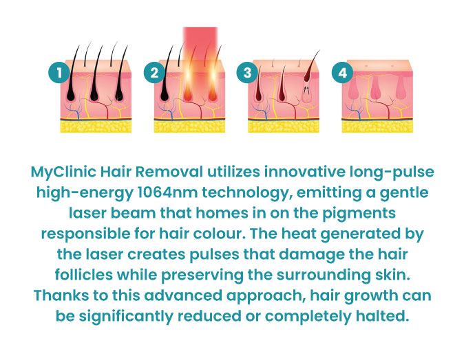 Image of How Does Hair Removal Laser Work