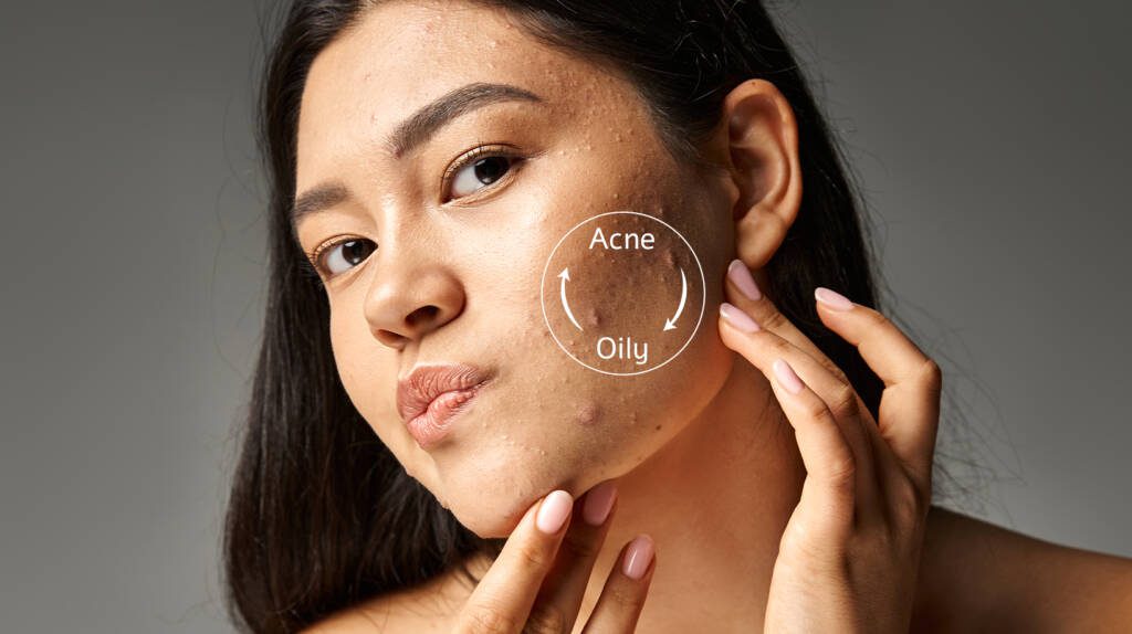 woman with acne problem