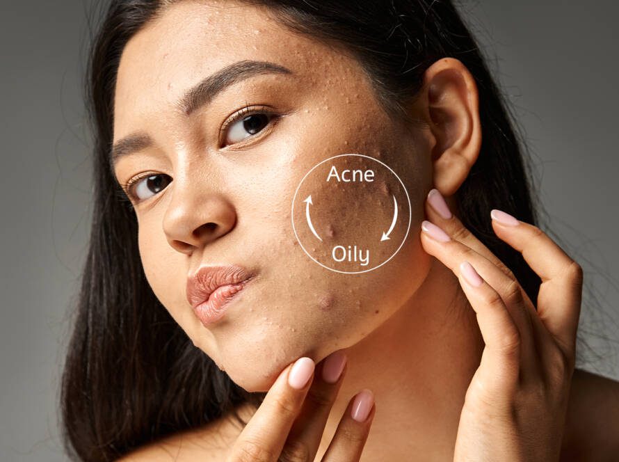 woman with acne problem