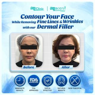 MyClinic- Your Trusted and #1 Choice

With just a few quick injections, you can enjoy a refreshed and revitalized look that radiates happiness and confidence.

Whether you're dealing with fine lines, wrinkles, or a loss of volume, fillers can help you achieve the youthful, vibrant appearance you've been seeking. Don't let emptiness keep you from feeling confident and beautiful. Fill the emptiness with happiness and rejuvenate your look with fillers. Book your appointment today!

Damansara Utama | Puchong | Cheras
Melawati | Mount Austin, JB | Bangi | Kelantan | Shah Alam | Sutera Utama, JB
⏰ Monday to Saturday 10.00am - 7.00pm
⏰ Sunday 10.00am - 6.00pm

#skincare #skin #care #aestheticclinic #beautician #skincareroutine #sales #laser #skincarecommunity