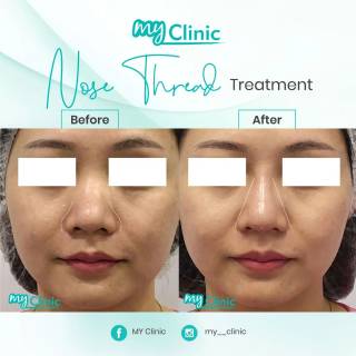 MyClinic- Your Trusted and #1 Choice
Enhance your nose effortlessly with nose threading treatment at MyClinic! ✨ 

Experience the benefits of a lifted nose tip, improved contour, and a slimmer nose bridge. Our minimally invasive procedure offers minimal downtime, allowing you to enjoy your results quickly. 

Achieve better definition and reduced width of your nose with our expert threading technique. Book your consultation at MyClinic and unlock your nose's full potential! 

Bentukkan hidung anda dengan rawatan nose threading di MyClinic! ✨

Dapatkan hidung tampak lebih mancung dan batang hidung yang lebih tinggi. Prosedur invasif minimum kami menawarkan masa pemulihan yang singkat, membolehkan anda mendapatkan hasil rawatan dengan cepat.

Tempah konsultasi anda di MyClinic untuk hidung yang lebih cantik!

Damansara Utama | Puchong | Cheras
Melawati | Mount Austin, JB | Bangi | Kelantan | Shah Alam | Sutera Utama, JB
⏰ Monday to Sunday 10.00 am - 6.30 pm

#MyClinic #MyClinic #MyClinicTreatment #MyClinicPromo #sale #aesthetickl #aestheticclinic #aesthetic #aestheticmalaysia #skinclinic #skinclinicmalaysia #klinikkulit #klinikkulitmalaysia #doktorkulitmalaysia #skincare #skindisease #medicalaesthetics #skinaesthetic #antiaging #lipfiller #nonsurgical #pigmentation #picolaser #yellowlaser #co2laser #fatfreezing #hairgrowth #slimming #rejuran #profhilo