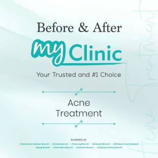 MyClinic- Your Trusted and #1 Choice
Transform your skin with MyClinic's highly effective acne treatment! ✨ 

Reveal a healthier, clearer complexion by bidding farewell to persistent breakouts. Our dedicated team of doctors understands the impact acne can have on your confidence, which is why we guarantee results. Trust in our proven methods and personalized approach to acne treatment. 

Take the first step towards radiant, blemish-free skin. Book your appointment at MyClinic today! 

Pulihkan kulit anda dengan rawatan jerawat MyClinic yang berkesan! ✨

Serlahkan kulit wajah yang sihat dan cerah dengan mengucapkan selamat tinggal kepada jerawat. Barisan doktor kami yang berdedikasi memahami kesan buruk jerawat terhadap keyakinan anda. Percayai kaedah kami yang terbukti dan direka khas untuk rawatan jerawat.

Ambil inisiatif pertama ke arah kulit yang cerah dan bebas cela. Tempah temujanji anda di MyClinic hari ini!

Damansara Utama | Puchong | Cheras
Melawati | Mount Austin, JB | Bangi | Kelantan | Shah Alam | Sutera Utama, JB
⏰ Monday to Sunday 10.00 am - 6.30 pm

#MyClinic #MyClinic #MyClinicTreatment #MyClinicPromo #sale #aesthetickl #aestheticclinic #aesthetic #aestheticmalaysia #skinclinic #skinclinicmalaysia #klinikkulit #klinikkulitmalaysia #doktorkulitmalaysia #skincare #skindisease #medicalaesthetics #skinaesthetic #antiaging #lipfiller #nonsurgical #pigmentation #picolaser #yellowlaser #co2laser #fatfreezing #hairgrowth #slimming #rejuran #profhilo