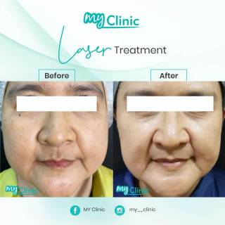 MyClinic- Your Trusted and #1 Choice
Radiant Skin with MyClinic's Laser Magic! ✨ 

Say goodbye to the top 5 skin concerns with our advanced laser treatments:
💡 Acne & Acne Scars
💡 Fine Lines & Wrinkles
💡 Uneven Skin Tone & Pigmentation
💡 Tattoo Removal
💡 Spider Veins

Our clinic offers a variety of laser treatments, each tailored to address specific concerns. Join the many delighted patients who have experienced successful results. Book a consultation now, and let us find the perfect laser solution for your unique skin needs ✨🔍 

Kulit Berseri dengan Rawatan Laser MyClinic! ✨

Ucapkan selamat tinggal kepada top 5 masalah kulit dengan rawatan laser kami:
💡 Jerawat & Parut Jerawat
💡 Garis Halus & Kedutan
💡 Tona Tidak Sekata & Pigmentasi Kulit
💡 Pembuangan Tatu
💡 Urat labah-labah

Klinik kami menawarkan pelbagai rawatan laser untuk menangani masalah kulit tertentu. Ramai pelanggan kami berpuas hati dengan hasil rawatan berjaya. Tempah konsultasi sekarang, dan doktor kami akan menyarankan rawatan laser terbaik untuk keperluan kulit anda yang unik ✨🔍

Damansara Utama | Puchong | Cheras
Melawati | Mount Austin, JB | Bangi | Kelantan | Shah Alam | Sutera Utama, JB
⏰ Monday to Sunday 10.00 am - 6.30 pm

#MyClinic #MyClinicPromo #aestheticclinic #aesthetic #aestheticmalaysia #skinclinic #skinclinicmalaysia #klinikkulit #klinikkulitmalaysia #doktorkulitmalaysia #skincare #skindisease #medicalaesthetics #skinaesthetic #antiaging #lipfiller #pigmentation #picolaser #yellowlaser #co2laser #fatfreezing #hairgrowth #slimming #rejuran #profhilo #hydrafacial #potenza #emface