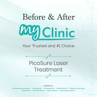 MyClinic- Your Trusted and #1 Choice
Make your clear skin dreams come true 🤩

PicoSure Laser treatment at MyClinic is the solution to flawless skin in a short time. 

Contact us now to book a consultation with our doctors & get the right treatment for your skin concerns 📱 

Dapatkan kulit tanpa cela yang anda impikan 🤩

Rawatan PicoSure Laser di MyClinic adalah penyelesaian kepada kulit yang sempurna tanpa cela dalam masa yang singkat.

Hubungi kami sekarang untuk menempah konsultasi dengan doktor kami & dapatkan rawatan yang sesuai untuk masalah kulit anda 📱

Damansara Utama | Puchong | Cheras
Melawati | Mount Austin, JB | Bangi | Kelantan | Shah Alam | Sutera Utama, JB
⏰ Monday to Sunday 10.00 am - 6.30 pm

#MyClinic #MyClinicTreatment #PicoSure