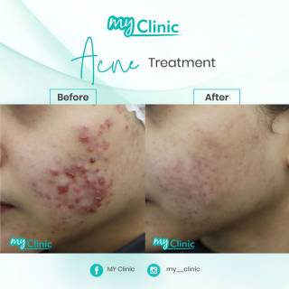 MyClinic- Your Trusted and #1 Choice
Transform your skin with MyClinic's highly effective acne treatment! ✨ 

Reveal a healthier, clearer complexion by bidding farewell to persistent breakouts. Our dedicated team of doctors understands the impact acne can have on your confidence, which is why we guarantee results. Trust in our proven methods and personalized approach to acne treatment. 

Take the first step towards radiant, blemish-free skin. Book your appointment at MyClinic today! 

Pulihkan kulit anda dengan rawatan jerawat MyClinic yang berkesan! ✨

Serlahkan kulit wajah yang sihat dan cerah dengan mengucapkan selamat tinggal kepada jerawat. Barisan doktor kami yang berdedikasi memahami kesan buruk jerawat terhadap keyakinan anda. Percayai kaedah kami yang terbukti dan direka khas untuk rawatan jerawat.

Ambil inisiatif pertama ke arah kulit yang cerah dan bebas cela. Tempah temujanji anda di MyClinic hari ini!

Damansara Utama | Puchong | Cheras
Melawati | Mount Austin, JB | Bangi | Kelantan | Shah Alam | Sutera Utama, JB
⏰ Monday to Sunday 10.00 am - 6.30 pm

#MyClinic #MyClinic #MyClinicTreatment #MyClinicPromo #sale #aesthetickl #aestheticclinic #aesthetic #aestheticmalaysia #skinclinic #skinclinicmalaysia #klinikkulit #klinikkulitmalaysia #doktorkulitmalaysia #skincare #skindisease #medicalaesthetics #skinaesthetic #antiaging #lipfiller #nonsurgical #pigmentation #picolaser #yellowlaser #co2laser #fatfreezing #hairgrowth #slimming #rejuran #profhilo