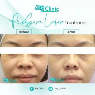 MyClinic- Your Trusted and #1 Choice
Make your clear skin dreams come true 🤩

PicoSure Laser treatment at MyClinic is the solution to flawless skin in a short time. 

Contact us now to book a consultation with our doctors & get the right treatment for your skin concerns 📱 

Dapatkan kulit tanpa cela yang anda impikan 🤩

Rawatan PicoSure Laser di MyClinic adalah penyelesaian kepada kulit yang sempurna tanpa cela dalam masa yang singkat.

Hubungi kami sekarang untuk menempah konsultasi dengan doktor kami & dapatkan rawatan yang sesuai untuk masalah kulit anda 📱

Damansara Utama | Puchong | Cheras
Melawati | Mount Austin, JB | Bangi | Kelantan | Shah Alam | Sutera Utama, JB
⏰ Monday to Sunday 10.00 am - 6.30 pm

#MyClinic #MyClinicTreatment #PicoSure