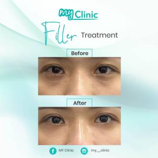 MyClinic- Your Trusted and #1 Choice
Rediscover your natural radiance with MyClinic! 🌟 

Our wide range of filler treatments is tailored to address specific facial concerns, whether it's enhancing lips, defining cheeks, or smoothing lines. Experienced doctors at MyClinic will provide personalized consultations, ensuring you receive the perfect filler for your unique needs. 

Join the countless satisfied clients who've experienced successful transformations with us. Contact us today to unveil a more confident you 💫 

Kembalikan kecantikan semula jadi anda dengan MyClinic! 🌟

Pelbagai jenis rawatan filler di MyClinic disediakan untuk menangani masalah wajah tertentu, dari membentuk bibir dan pipi hingga memudarkan garis halus. Doktor berpengalaman di MyClinic akan memberikan konsultasi terbaik bagi memastikan anda mendapatkan rawatan filler yang tepat mengikut keperluan.

Jadi salah satu dari pelanggan yang berpuas hati dengan rawatan bersama kami. Hubungi kami hari ini untuk meningkatkan keyakinan diri 💫

Damansara Utama | Puchong | Cheras
Melawati | Mount Austin, JB | Bangi | Kelantan | Shah Alam | Sutera Utama, JB
⏰ Monday to Sunday 10.00 am - 6.30 pm

#MyClinic #MyClinic #MyClinicTreatment #MyClinicPromo #sale #aesthetickl #aestheticclinic #aesthetic #aestheticmalaysia #skinclinic #skinclinicmalaysia #klinikkulit #klinikkulitmalaysia #doktorkulitmalaysia #skincare #skindisease #medicalaesthetics #skinaesthetic #antiaging #lipfiller #nonsurgical #pigmentation #picolaser #yellowlaser #co2laser #fatfreezing #hairgrowth #slimming #rejuran #profhilo