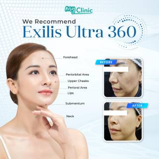 MyClinic- Your Trusted and #1 Choice
Experience the magic of Exilis Ultra 360 at MyClinic! ✨ 

Achieve firm, radiant skin from head to toe with our all-in-one treatment. No pain, no downtime – just pure skin rejuvenation. Book your appointment now, and let our expert consultations guide you to the best version of yourself! 🌟

Rasai keajaiban Exilis Ultra 360 di MyClinic! ✨

Dapatkan kulit tegang dan berseri dari hujung rambut hingga hujung kaki dengan rawatan semua-dalam-satu kami. Tanpa kesakitan, tanpa masa pemulihan - hanya rawatan peremajaan kulit secara semula jadi. Tempah temujanji sekarang, dan dapatkan konsultasi terbaik dari doktor kami! 🌟

Damansara Utama | Puchong | Cheras
Melawati | Mount Austin, JB | Bangi | Kelantan | Shah Alam | Sutera Utama, JB
⏰ Monday to Sunday 10.00 am - 6.30 pm

#MyClinic #MyClinicPromo #aestheticclinic #aesthetic #aestheticmalaysia #skinclinic #skinclinicmalaysia #klinikkulit #klinikkulitmalaysia #doktorkulitmalaysia #skincare #skindisease #medicalaesthetics #skinaesthetic #antiaging #lipfiller #pigmentation #picolaser #yellowlaser #co2laser #fatfreezing #slimming #rejuran #profhilo #hydrafacial #potenza #emface #thermage #ultherapy