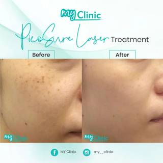 MyClinic- Your Trusted and #1 Choice
Make your clear skin dreams come true 🤩

PicoSure Laser treatment at MyClinic is the solution to flawless skin in a short time. 

Contact us now to book a consultation with our doctors & get the right treatment for your skin concerns 📱 

Dapatkan kulit tanpa cela yang anda impikan 🤩

Rawatan PicoSure Laser di MyClinic adalah penyelesaian kepada kulit yang sempurna tanpa cela dalam masa yang singkat.

Hubungi kami sekarang untuk menempah konsultasi dengan doktor kami & dapatkan rawatan yang sesuai untuk masalah kulit anda 📱

Damansara Utama | Puchong | Cheras
Melawati | Mount Austin, JB | Bangi | Kelantan | Shah Alam | Sutera Utama, JB
⏰ Monday to Sunday 10.00 am - 6.30 pm

#MyClinic #MyClinicTreatment #PicoSure