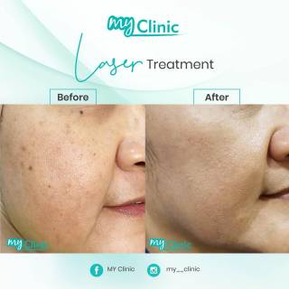 MyClinic- Your Trusted and #1 Choice
Radiant Skin with MyClinic's Laser Magic! ✨ 

Say goodbye to the top 5 skin concerns with our advanced laser treatments:
💡 Acne & Acne Scars
💡 Fine Lines & Wrinkles
💡 Uneven Skin Tone & Pigmentation
💡 Tattoo Removal
💡 Spider Veins

Our clinic offers a variety of laser treatments, each tailored to address specific concerns. Join the many delighted patients who have experienced successful results. Book a consultation now, and let us find the perfect laser solution for your unique skin needs ✨🔍 

Kulit Berseri dengan Rawatan Laser MyClinic! ✨

Ucapkan selamat tinggal kepada top 5 masalah kulit dengan rawatan laser kami:
💡 Jerawat & Parut Jerawat
💡 Garis Halus & Kedutan
💡 Tona Tidak Sekata & Pigmentasi Kulit
💡 Pembuangan Tatu
💡 Urat labah-labah

Klinik kami menawarkan pelbagai rawatan laser untuk menangani masalah kulit tertentu. Ramai pelanggan kami berpuas hati dengan hasil rawatan berjaya. Tempah konsultasi sekarang, dan doktor kami akan menyarankan rawatan laser terbaik untuk keperluan kulit anda yang unik ✨🔍

Damansara Utama | Puchong | Cheras
Melawati | Mount Austin, JB | Bangi | Kelantan | Shah Alam | Sutera Utama, JB
⏰ Monday to Sunday 10.00 am - 6.30 pm

#MyClinic #MyClinicPromo #aestheticclinic #aesthetic #aestheticmalaysia #skinclinic #skinclinicmalaysia #klinikkulit #klinikkulitmalaysia #doktorkulitmalaysia #skincare #skindisease #medicalaesthetics #skinaesthetic #antiaging #lipfiller #pigmentation #picolaser #yellowlaser #co2laser #fatfreezing #hairgrowth #slimming #rejuran #profhilo #hydrafacial #potenza #emface