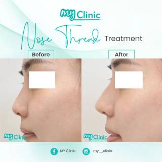 MyClinic- Your Trusted and #1 Choice
Enhance your nose effortlessly with nose threading treatment at MyClinic! ✨ 

Experience the benefits of a lifted nose tip, improved contour, and a slimmer nose bridge. Our minimally invasive procedure offers minimal downtime, allowing you to enjoy your results quickly. 

Achieve better definition and reduced width of your nose with our expert threading technique. Book your consultation at MyClinic and unlock your nose's full potential! 

Bentukkan hidung anda dengan rawatan nose threading di MyClinic! ✨

Dapatkan hidung tampak lebih mancung dan batang hidung yang lebih tinggi. Prosedur invasif minimum kami menawarkan masa pemulihan yang singkat, membolehkan anda mendapatkan hasil rawatan dengan cepat.

Tempah konsultasi anda di MyClinic untuk hidung yang lebih cantik!

Damansara Utama | Puchong | Cheras
Melawati | Mount Austin, JB | Bangi | Kelantan | Shah Alam | Sutera Utama, JB
⏰ Monday to Sunday 10.00 am - 6.30 pm

#MyClinic #MyClinic #MyClinicTreatment #MyClinicPromo #sale #aesthetickl #aestheticclinic #aesthetic #aestheticmalaysia #skinclinic #skinclinicmalaysia #klinikkulit #klinikkulitmalaysia #doktorkulitmalaysia #skincare #skindisease #medicalaesthetics #skinaesthetic #antiaging #lipfiller #nonsurgical #pigmentation #picolaser #yellowlaser #co2laser #fatfreezing #hairgrowth #slimming #rejuran #profhilo