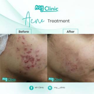 MyClinic- Your Trusted and #1 Choice
Transform your skin with MyClinic's highly effective acne treatment! ✨ 

Reveal a healthier, clearer complexion by bidding farewell to persistent breakouts. Our dedicated team of doctors understands the impact acne can have on your confidence, which is why we guarantee results. Trust in our proven methods and personalized approach to acne treatment. 

Take the first step towards radiant, blemish-free skin. Book your appointment at MyClinic today! 

Pulihkan kulit anda dengan rawatan jerawat MyClinic yang berkesan! ✨

Serlahkan kulit wajah yang sihat dan cerah dengan mengucapkan selamat tinggal kepada jerawat. Barisan doktor kami yang berdedikasi memahami kesan buruk jerawat terhadap keyakinan anda. Percayai kaedah kami yang terbukti dan direka khas untuk rawatan jerawat.

Ambil inisiatif pertama ke arah kulit yang cerah dan bebas cela. Tempah temujanji anda di MyClinic hari ini!

Damansara Utama | Puchong | Cheras
Melawati | Mount Austin, JB | Bangi | Kelantan | Shah Alam | Sutera Utama, JB
⏰ Monday to Sunday 10.00 am - 6.30 pm

#MyClinic #MyClinic #MyClinicTreatment #MyClinicPromo #sale #aesthetickl #aestheticclinic #aesthetic #aestheticmalaysia #skinclinic #skinclinicmalaysia #klinikkulit #klinikkulitmalaysia #doktorkulitmalaysia #skincare #skindisease #medicalaesthetics #skinaesthetic #antiaging #lipfiller #nonsurgical #pigmentation #picolaser #yellowlaser #co2laser #fatfreezing #hairgrowth #slimming #rejuran #profhilo